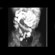 Crohn's disease of ileum: RF - Fluoroscopy